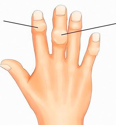 Artrozlu interfalangeal eklemlerdeki Heberden ve Bouchard düğümleri