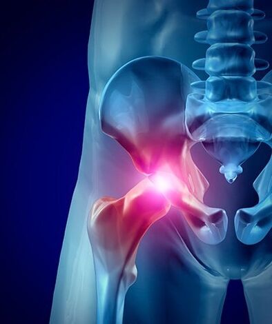 kalça ağrısı fotoğraf 1
