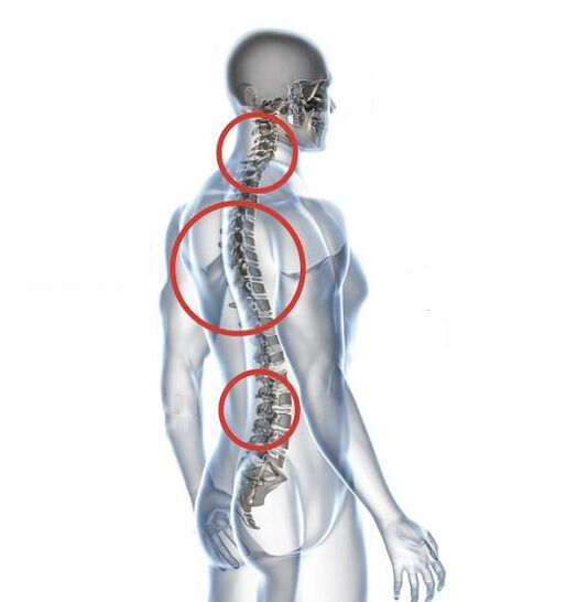 Osteokondroz nasıl ortaya çıkar