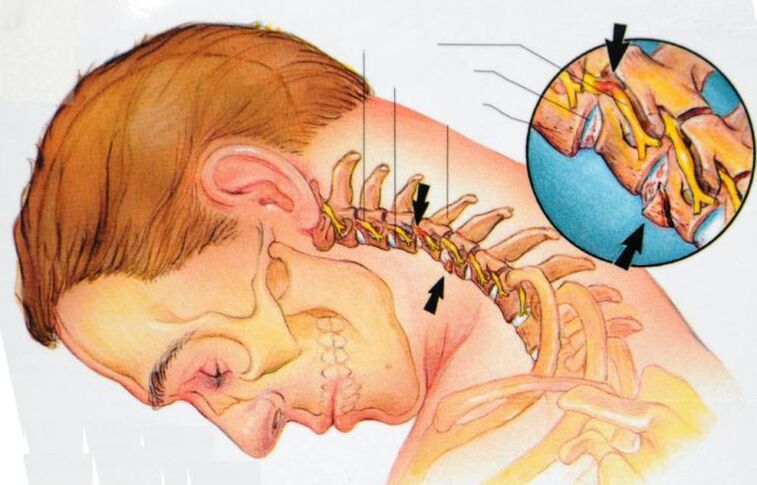 servikal osteokondroz belirtileri