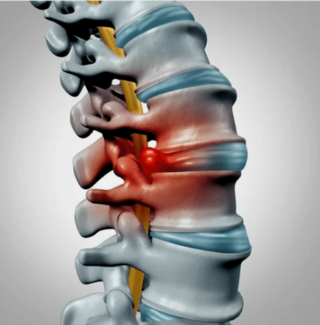 İntervertebral disklerin korunması